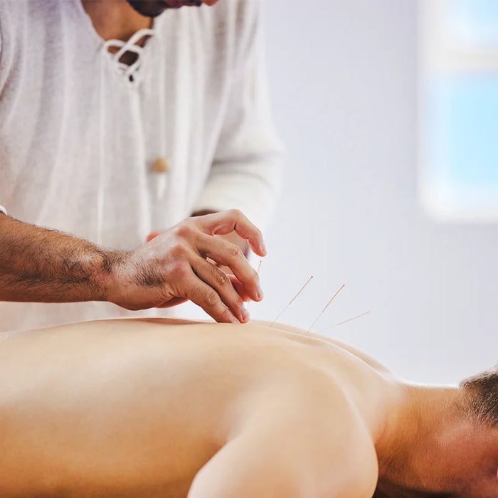 Fine dry needling filaments placed along a patient’s upper back