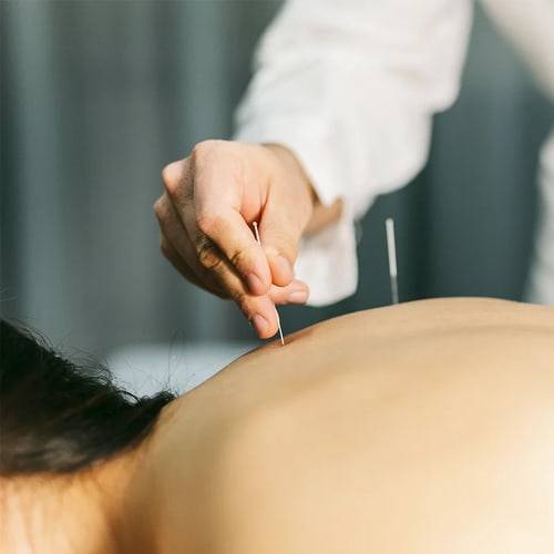 Practitioner precisely placing a thin dry needling filament in a patient’s back